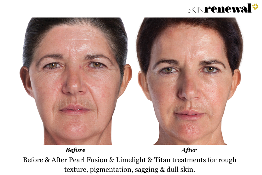 Dull Rough Texture Pigmentation Pearl Laser Titan Limelight Before and After