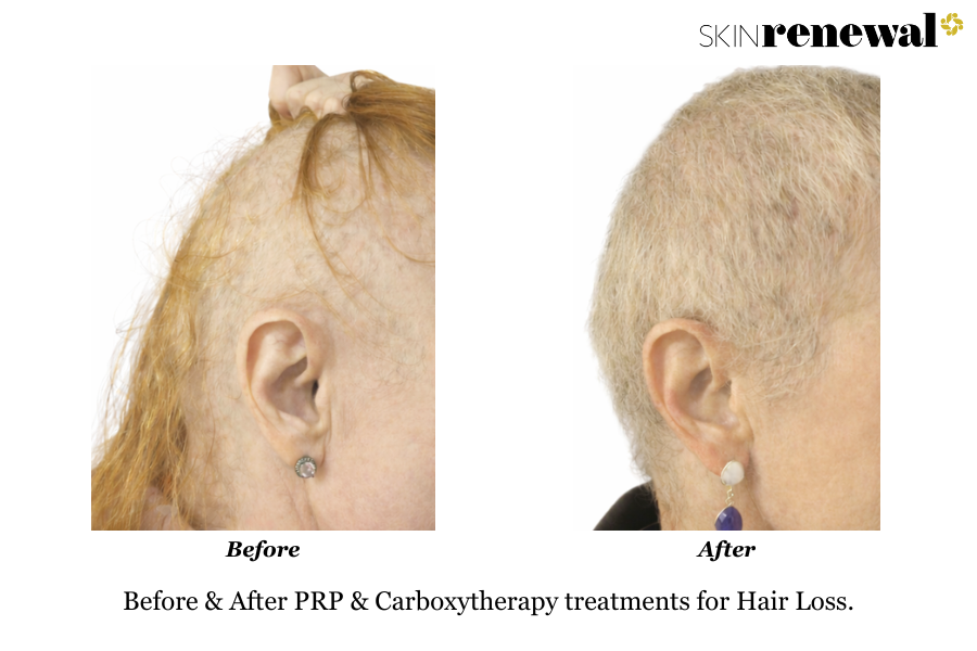 Hair Loss PRP Mesotherapy Carboxytherapy