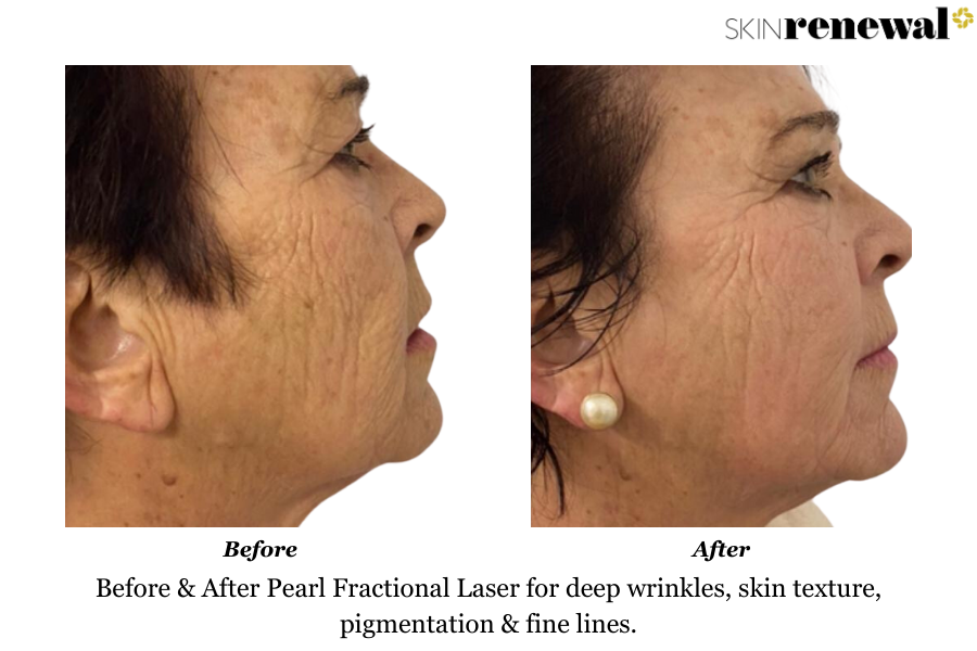 Wrinkles Pearl Fractional Before and After