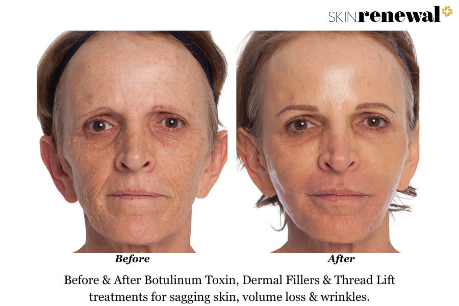 Ageing Skin Volume Loss Botulinum Toxin Dermal Fillers Before and After