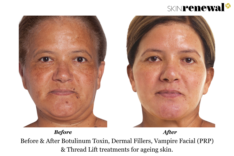 Ageing Skin Botulinum Toxin Dermal Fillers PRP Before And After