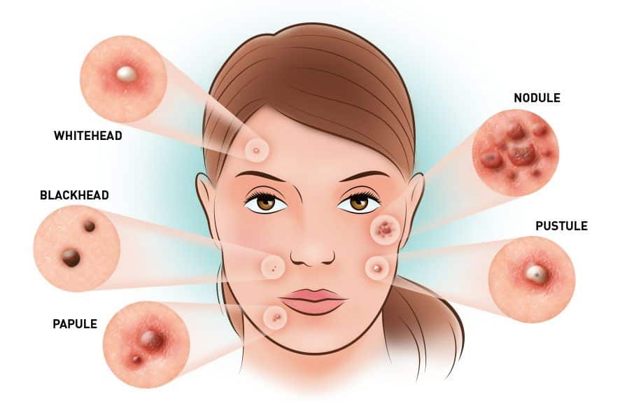 Skin Renewal different types of acne lesions