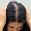 Why GLP-1 Weight Loss Can Trigger Hair Loss