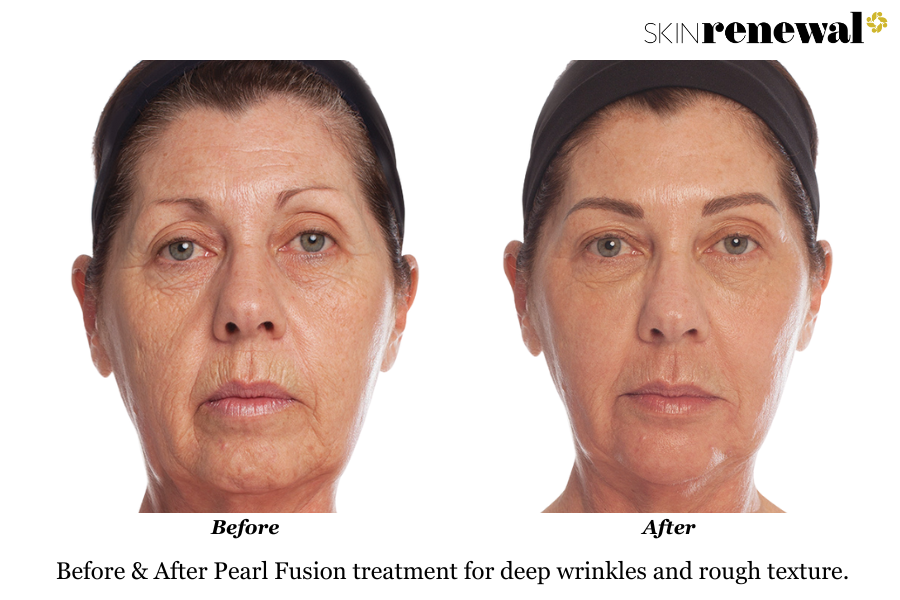 Deep Wrinkles Rough Texture Pearl Fusion Before and After