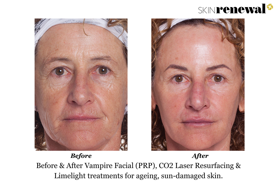 Ageing Sun Damage PRP CO2 Limelight Before and After